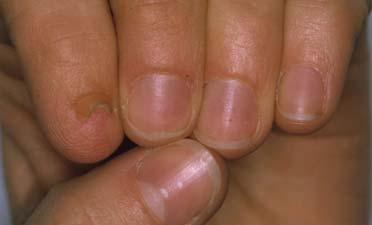 Iso Kikuchi syndrome micronychia of both index fingers. Fig. 2.
