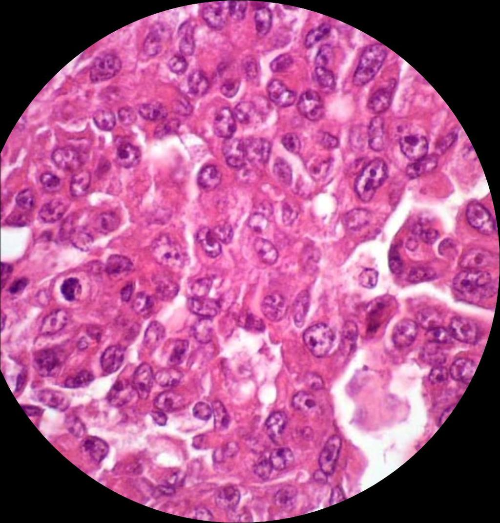 Pathology Epithelioid (50%) Sarcomatoid (16%) Biphasic (34%) The histologic appearance of MPM is