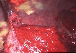 2. VATS Pleurectomy Decortication Three 2 cm ports Parietal