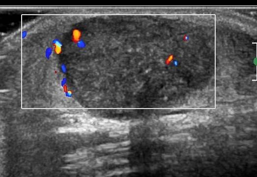 Transverse greyscale () and Doppler () US images of the posterior midline neck