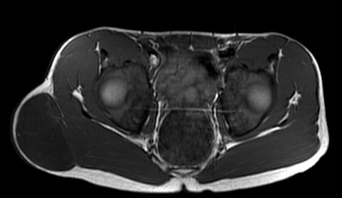 well circumscribed T1-hypointense lesion in the right hip.