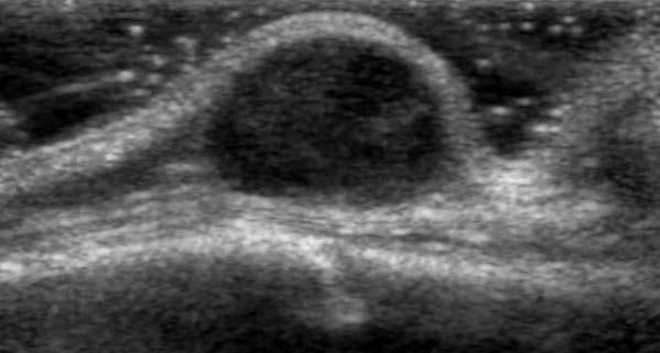 Transverse US image demonstrates a subcentimeter hypoechoic avascular well defined cystic mass with extension through the
