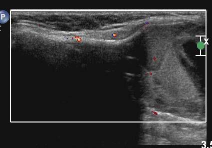 . Transverse Doppler US image of the right medial clavicular region demonstrates marked