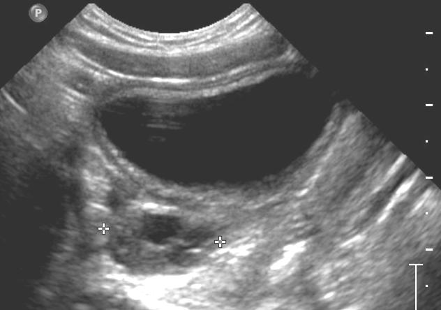 Ovarian torsion LDDER RT OV SG LT GROIN TRV 4 month old female with left groin mass and vomiting.