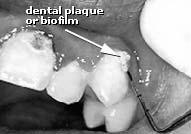 mutans) Dental plaque Acid Demineralization 36 http://dent.umich.