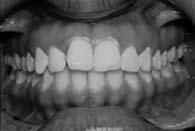 Local aggressive (juvenile) periodontitis: Clinical & radiographic features 46 Local aggressive