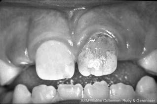 Human dental plaque 4 Life in the mouth: oral biofilm Hundreds of species (less than half are cultured)