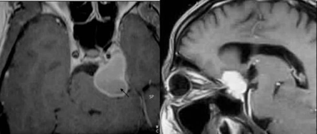 Fig. 2: Axial and sagittal enhanced T1weighted MR images: left sphenoid wing