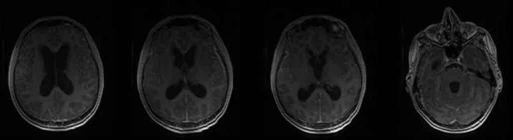 3: Meningeal carcinomatosis: Axial enhanced T1Weighted images: Diffuse linear
