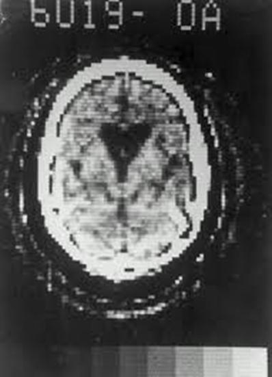 performs cerebral angiography 1971 Godfrey