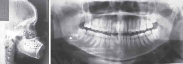 A conventional Begg treatment procedure was initiated after extraction of the four second premolars.