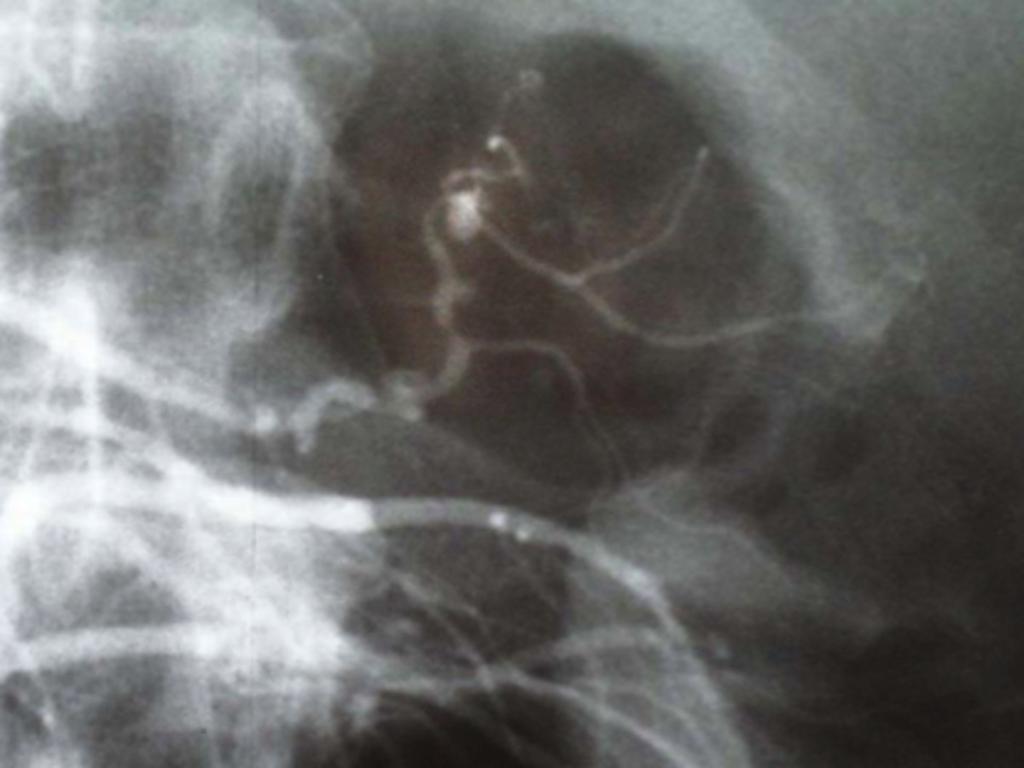 Fig.: 7. Superior mesenteric artery involvement in PAN.