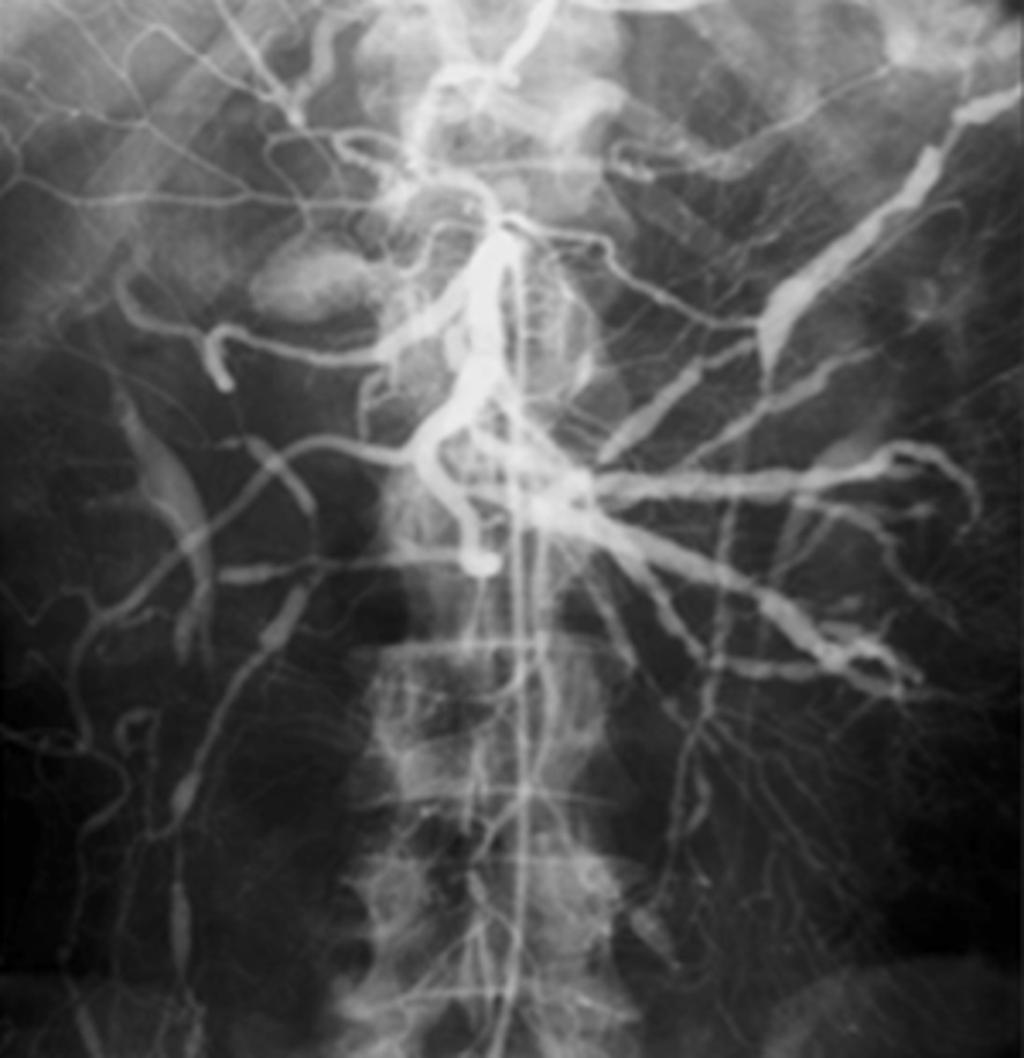 Fig.: 8. Segmental arteriolar mediolysis.