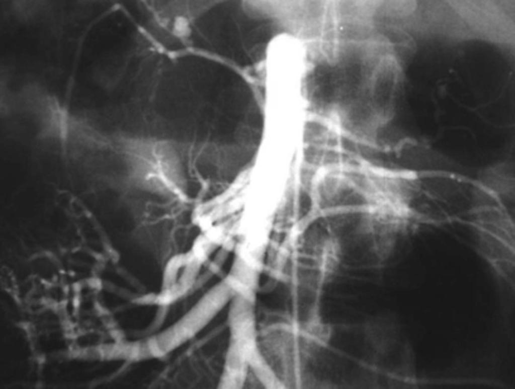 Fig.: 4. Diffuse involvement of the abdominal visceral arteries with PAN.