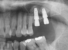Before injecting OSTEON TM, remove