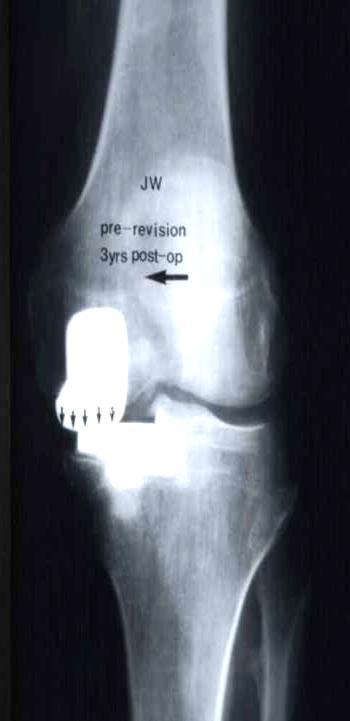 Current OA Treatments: Tale of Two Procedures Total Knee Arthroplasty