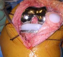 Arthroplasty For early stage OA 1 or 2 compartments Technically