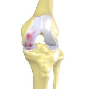 Volume x 1000 Late stage Mid stage Early stage MAKO Market Opportunity 800 700 600 Primary Knee Arthroplasty U.S.