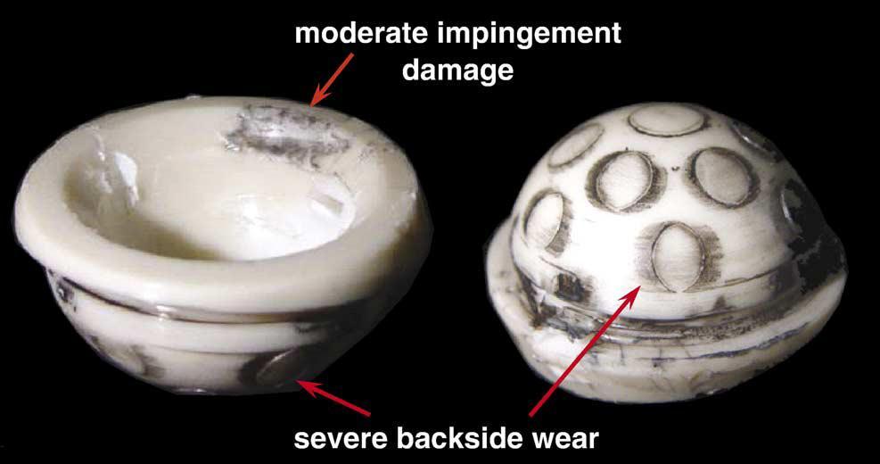 Liner and Backside Wear Caused by Impingement Acetabular insert displaying both severe