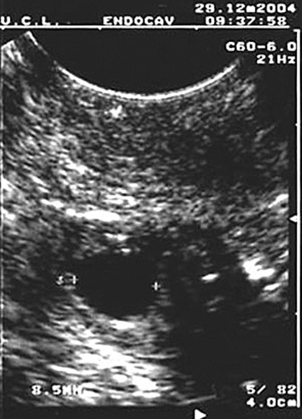 J.Donnez et al. Figure 3. Four-and-a-half months after reimplantation, ultrasonography demonstrated the presence of a follicle of 9.2 mm in size, which reached 14 mm 3 days before the LH peak.