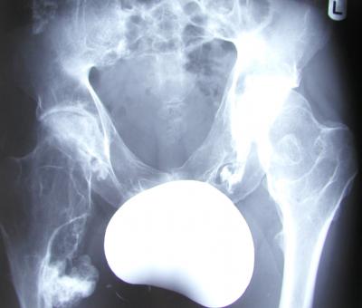 Figure 1 Figure 1: Preoperative x-ray of the pelvis including both hip joints. It shows bilateral coxa valga with broaden femoral neck and metaphysis of femur.