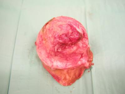 Intra-operatively, the following was noted; the femoral head and neck was deformed with an increase neck/shaft ratio (figure 2 and 3), the acetabulum was noted to be shallow.