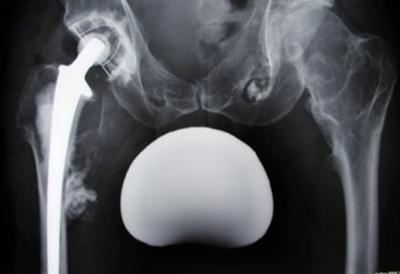 Figure 5 Figure 5: Postoperative x-ray. The hip is reduced and the implant is well cemented in.
