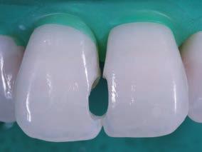 81 - After removal of the defective restorations and carious tissue, the enamel is etched with phosphoric acid, and the bonding procedure is performed.