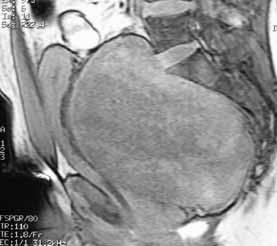 femoral vein on the left side. A tumor of 10 x 8 cm was found in the left side of the pelvis, which was compressing the sciatic nerve.