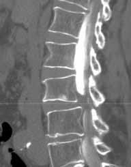 elography and CT were performed, which revealed severe spinal stenosis with a partial block at the L3 L4 and L4 L5 level (Figures 4 and 5).