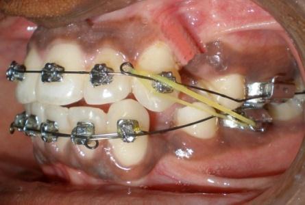 TREATMENT PROGRESS AND RESULTS: Orthodontic treatment started with Tip-Edge Plus