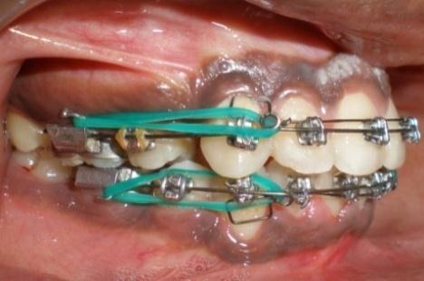 Overjet reduction, arch alignment, overbite reduction and space closure were thus