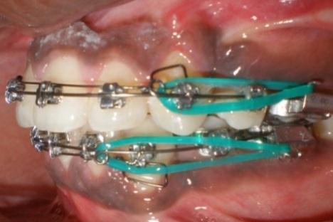 The box-auxillary were placed on canines to correct buccal torque loss of the