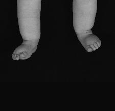 The Ponseti technique is applied in several stages: 1. Casts and gentle specific stretches of your child s foot/feet weekly for approximately four-six weeks. 2.