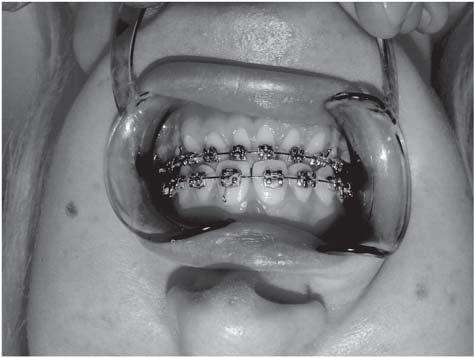 After six months, the gap was filled with osseous tissue. Figure 7 demonstrates patient occlusion before surgery with brackets in place over the upper and lower teeth.