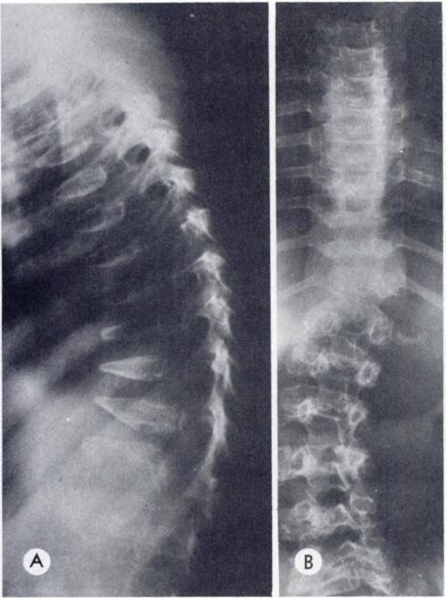 SPONDYLOMETAPHYSEAL DYSPLASIA 91 Fig. 4.-Spinal radiographs of father. A. Lateral dorsal spine at 6 years. B.