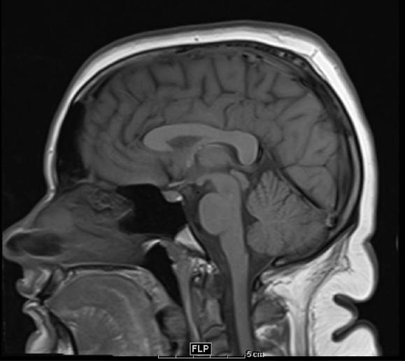 for comparison Mid-sagittal T1 MRI of the brain shows caudal displacement of