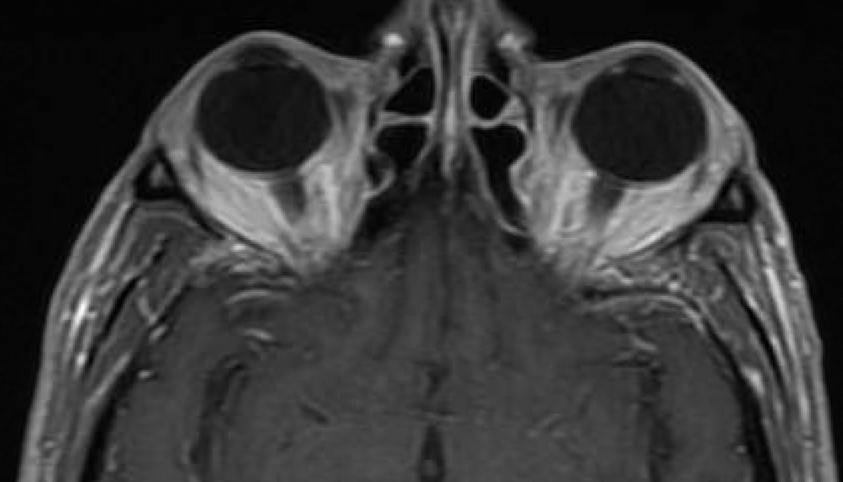 arrow) Normal axial T1 MRI shown for comparison Flattening of the posterior globes