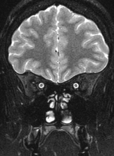 contrast Axial T2 FLAIR MRI of the
