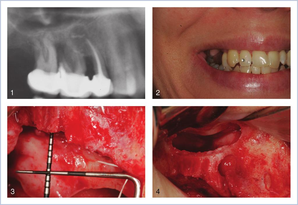 Istvan Urban et al FIGURES 1 4. FIGURE 1. Failing dentition on the right posterior maxilla. FIGURE 2. Esthetically and functionally demanding severe vertical defect. FIGURE 3.