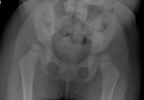 Neuromuscular Hip Dysplasia 17 Months Tone and growth 26 Months 14 Neuromuscular Hip Dislocation Usually