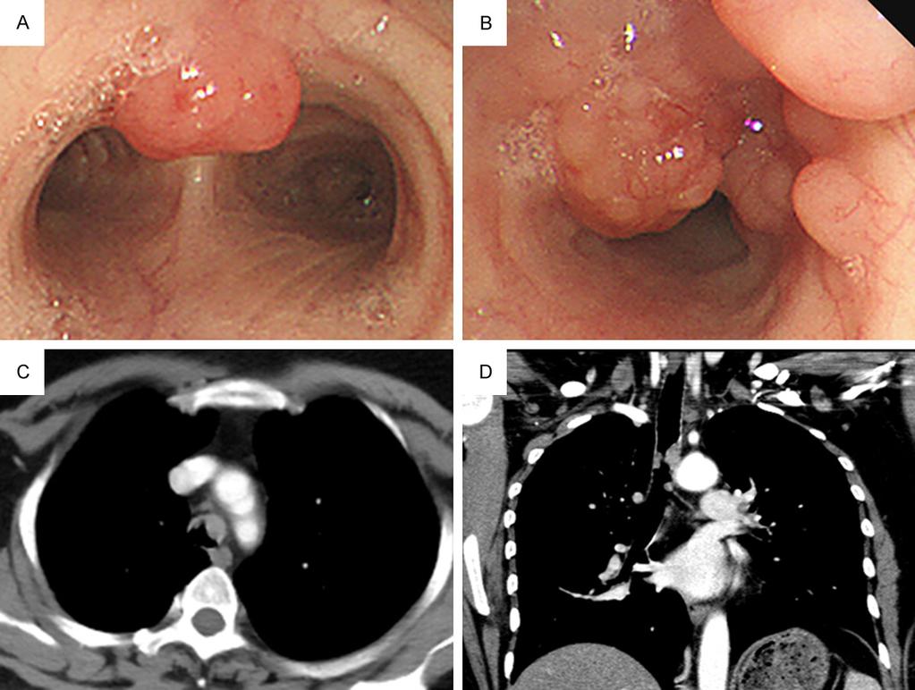 Figure 1. Tracheal tumor before resection. A, B: Bronchoscopy showed multiple nodular masses in the trachea. C, D: Chest CT revealed multiple soft tissue nodules in the lower part of the trachea.