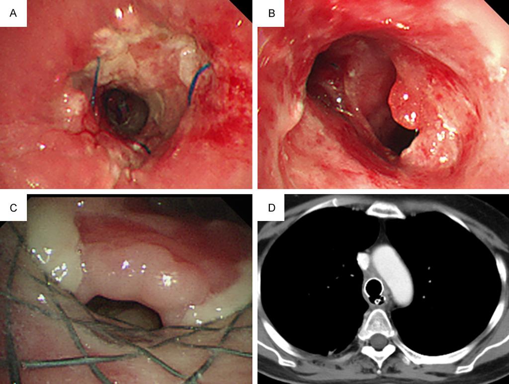Figure 2. Complications after tracheal resection. (A) Bronchoscopy showed TS with a diameter of ~0.7 cm, (B) left main bronchial opening stenosis with a diameter of ~0.