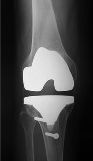 Figure 2: Intraoperative findings of tibial tubercle osteotomy in primary total knee arthroplasty for valgus knee deformity.