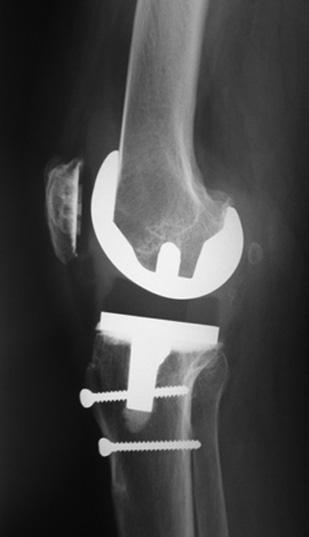 After tibial tubercle osteotomy was performed from the lateral side, the bone fragment was everted from the lateral to the medial side, leaving the medial soft tissue attachment intact.