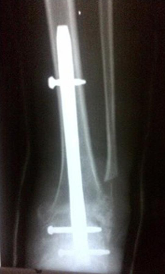 After 4-year follow-up, the only complication was late skin problem related to one of the distal locking screws in the