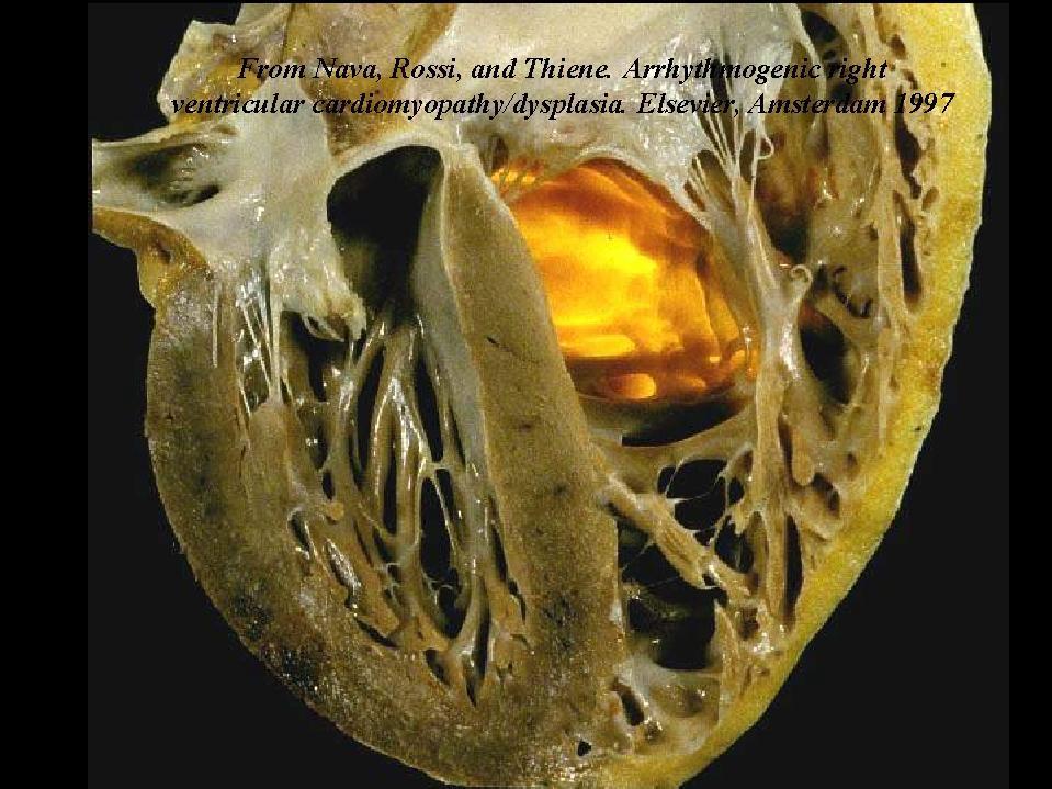 Arrhythmogenic Right Ventricular Cardiomyopathy Arrhythmogenic right ventricular cardiomyopathy (ARVC) is an heart muscle