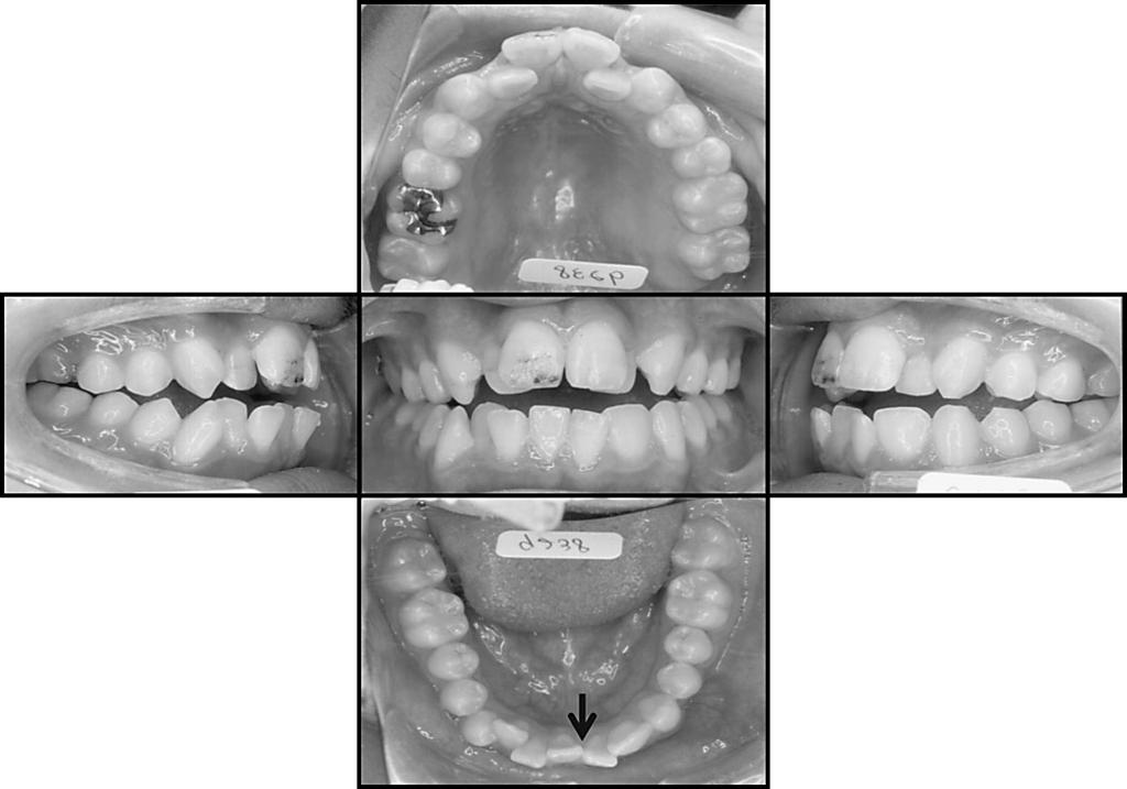 20 Yokose T et al. Fig. 1 Intraoral photographs Mark shows mandible dental midline, determined by positional relationship of lingual frenum and inferior labial frenum.