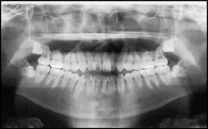 However, there have been few detailed reports 3,6,8,10,11) on the etiology of supernumerary teeth or differential diagnoses of normal and supernumerary teeth.