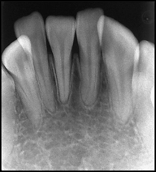 Two Rare Cases of Supernumerary Teeth 21 Fig. 4 Mandibular anterior Fig.